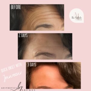 ANTI-WRINKLE Before and After (1)