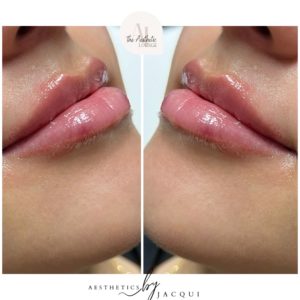 lip-fillers-aestheticloungeli (7)