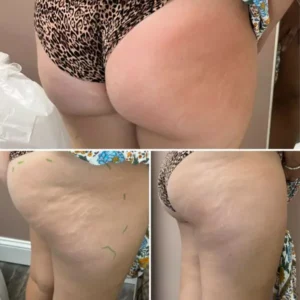 cellulite1