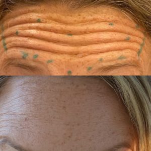 aesthetic lounge botox gallery d