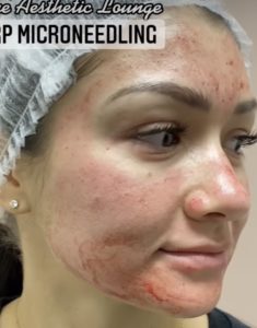 aesthetic lounge microneedling gallery b