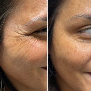 ANTI-WRINKLE Before and After (2)