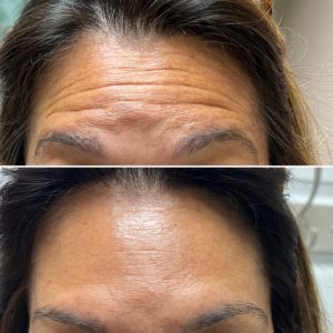 ANTI-WRINKLE Before and After (3)