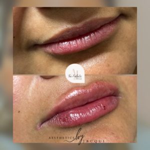 Lip Filler Before and After (1)
