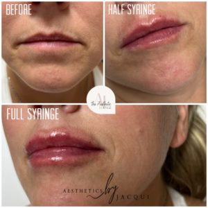 Lip Filler Before and After (2)