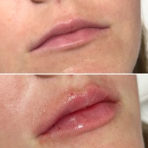 lip-fillers-aestheticloungeli (8)