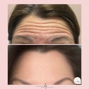 botox-b-a 2