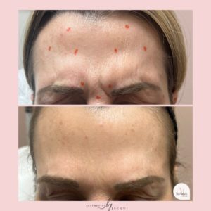 botox-b-a-5-min