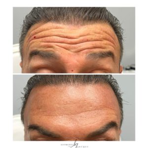 botox-b-a-6-min