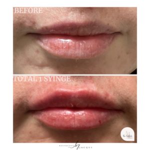 lip-filler-b-a-7